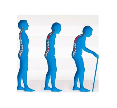 Osteoporose17