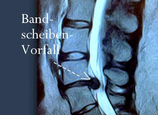 großer Bandscheibenvorfall